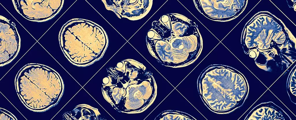 Unraveling the Mystery of Alzheimer’s Resilience: A Unique Case Study