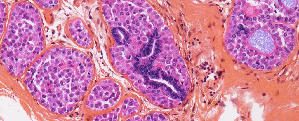 Revolutionizing Breast Cancer Care: Targeting Dormant Cells to Eradicate Recurrence